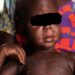 Santé : 1269 cas suspects de rougeole détectés au Burkina Faso
